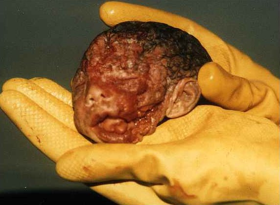 Abortion: The Ultimate Child Abuse