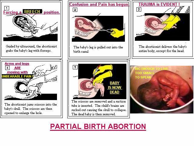 what is abortion
